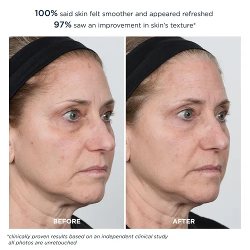 Vista 7 de M-61 PowerGlow® Peel Extra Strength 20%