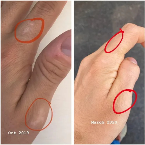 Vista 6 de Suplemento vitamínico y mineral de vitíligo para la mancha blanca y la pigmentación de la piel - Suministro para 6 meses - Terapia de tratamiento
