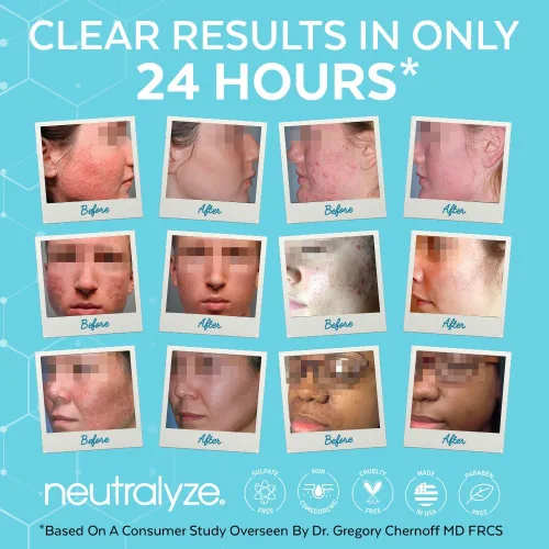 Vista 4 de Neutralyze Renewal Complex Crema hidratante para acné para cara, liberación temporal, grado médico 2% ácido mandélico y ácido salicílico, crema