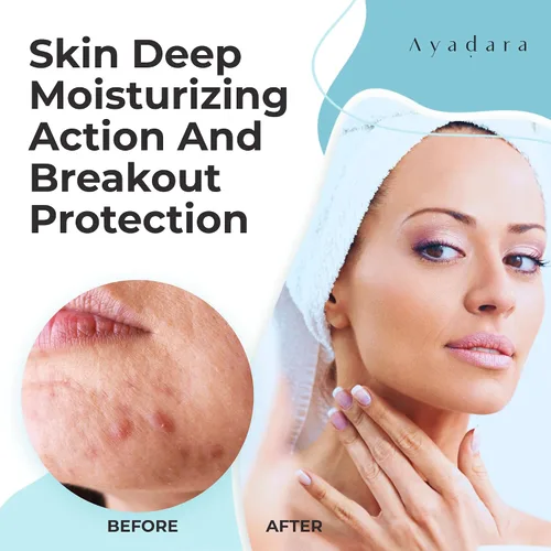 Vista 3 de Crema hidratante para el acné, hidratante facial de ácido salicílico para pieles grasas y propensas al acné, ayuda con espinillas, puntos negros