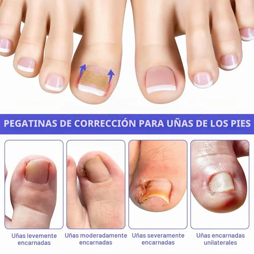 Vista 5 de Parche corrector de uñas encarnadas, 100 tiras correctoras de uñas encarnadas, parches de corrección de uñas de los pies, herramienta de tratamiento