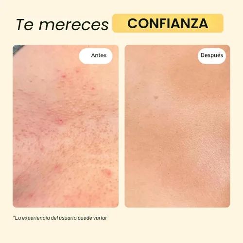 Vista 5 de MyMagicHealer Universal Flare Care Pomada Extractora para HS, forúnculos, quistes, hemorroides, quiste pilonidal, absceso Anti-rozaduras