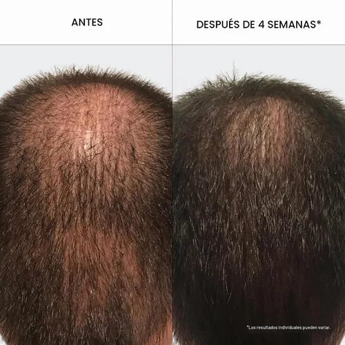 Vista 6 de Zenagen Revolve - Dúo de pérdida de cabello para hombre, 2.5 onzas líquidas