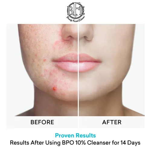 Vista 5 de Tratamiento de lavado facial para acné con peróxido de benzoilo – Combate las imperfecciones del acné al contacto para brotes quísticos, piel grasa