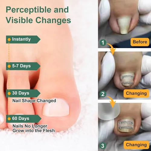 Vista 3 de Corrector de uñas encarnadas de nitinol dual, tratamiento de uñas encarnadas, enderezador de uñas curvas, kit de eliminación de uñas encarnadas