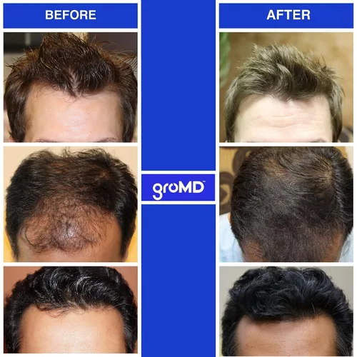Vista 4 de GroMD Folículo activador en aerosol y champú estimulante del crecimiento del cabello y acondicionador – Biotina, aceite de argán, péptidos de cobre