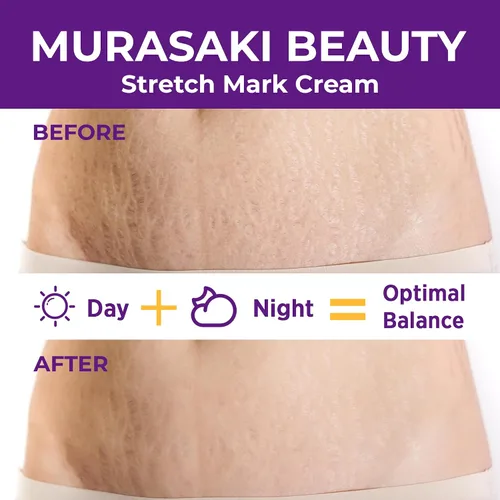 Vista 2 de Crema para prevención de estrías para el embarazo, crema de maternidad para eliminar estrías, fórmula nutritiva, evita estrías y mejora