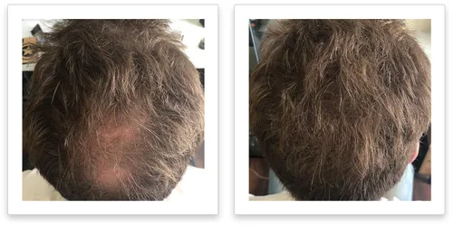 Vista 4 de FEBRON Fibras capilares para adelgazar el cabello para mujeres y hombres, corrector de pérdida de cabello, polvo para el cabello, base de Marrón