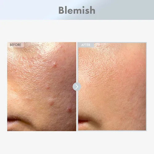 Vista 2 de TOSOWOONG Suero facial de niacinamida al 15%, niacinamida de 150,100 ppm, ácido tranexámico, corrector de manchas oscuras, piel de vidrio, tez