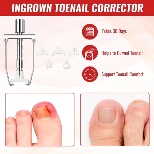 Vista 7 de Kit de eliminación de uñas encarnadas, kit de herramientas de uñas encarnadas con corrector de uñas encarnadas, gotas de uñas encarnadas, parche