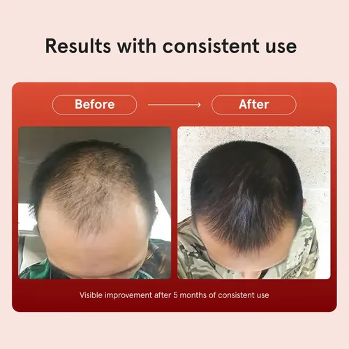 Vista 3 de Keeps Extra Strength Minoxidil para hombres - 5% espuma de minoxidil para pérdida y crecimiento del cabello para zonas delgadas y calvas - productos