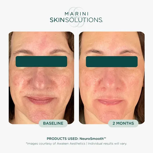 Vista 3 de Marini SkinSolutions NeuroSmooth - Suero facial neuromodulante alimentado por péptidos para piel suave como el vidrio y sin poros, libre
