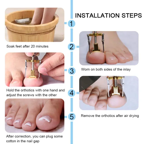 Vista 2 de Corrector de uñas encarnadas profesional encarnadas levantador de uñas encarnadas práctica abrazadera para el tratamiento de uñas encarnadas