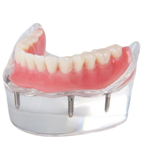 Vista 2 de Modelo de restauración dental con 4 implantes Sobredentadura Inferior Enseñanza Estudio Modelo de Dientes