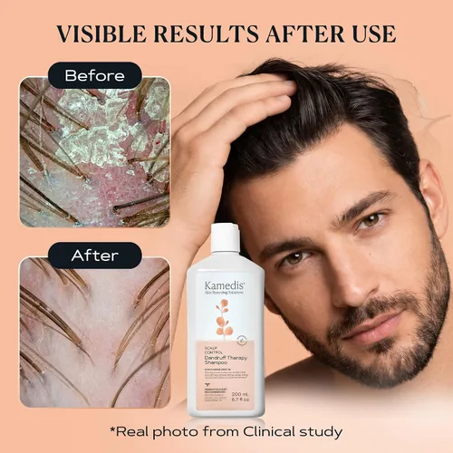 Vista 5 de Kamedis Champú anticaspa para cuero cabelludo sensible y dermatitis seborreica, libre de crueldad, sin parabenos, 6.7 oz