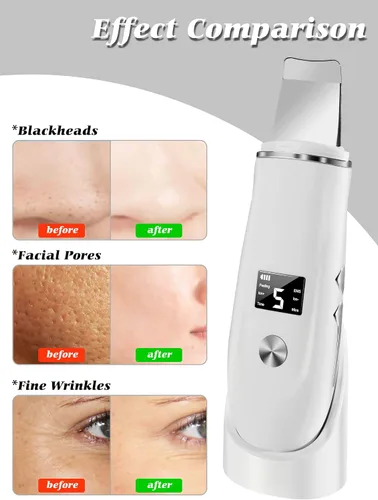 Vista 6 de Raspador de Piel Espátula Facial, Herramienta Removedora de Puntos Negros 4 en 1 para Limpiador de Poros, Raspador de Piel Espátula Facial