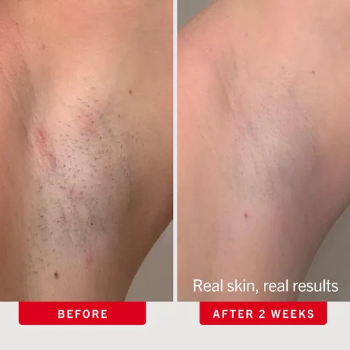 Vista 4 de First Aid Beauty Ingrown Hair Pads with BHA and AHA