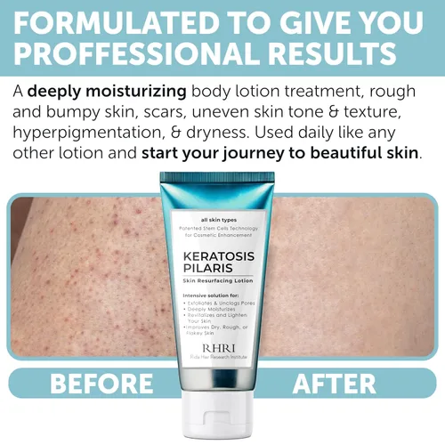Vista 4 de Tratamiento de queratosis pilaris Loción de queratosis pilaris con 10% AHA Exfoliación suave para piernas de fresa, KP y pelos encarnados