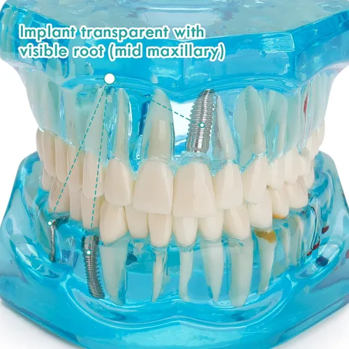 Vista 4 de Modelo de dientes de implante dental transparente - Modelo de dientes de enfermedad transparente Modelo de dientes patológicos con dientes