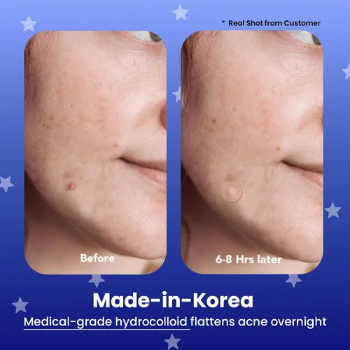 Vista 2 de AVARELLE Parches de espinillas para la cara Good Night Acné Cover Hidrocoloide con aceite de árbol de té Tratamiento de manchas de acné