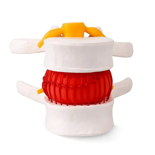 Vista 2 de Modelo de hernia de disco lumbar anatómica humana, modelo de hernia de disco lumbar de tamaño real - Modelo de columna lumbar para enseñar