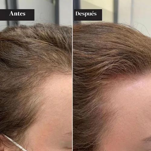 Vista 6 de Kit de renovación de cabello con micro infusión, suero para el cabello con ácido hialurónico, péptido y ampollas de suero botánico