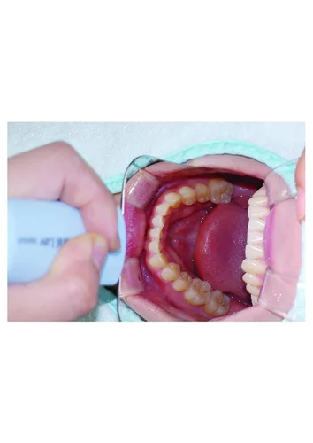 Vista 2 de OSUNG - Espejo dental para fotografía intraoral con mango (oclusal pequeño)