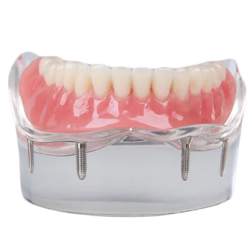Vista 3 de Modelo de restauración dental con 4 implantes Sobredentadura Inferior Enseñanza Estudio Modelo de Dientes