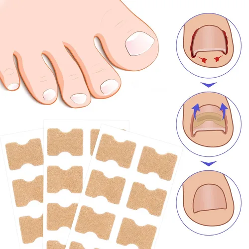 Vista 3 de Parche corrector de uñas encarnadas, 100 tiras correctoras de uñas encarnadas, parches de corrección de uñas de los pies, herramienta de tratamiento