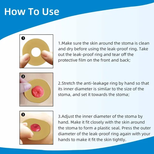 Vista 6 de Anillos de barrera para ostomía, anillos de ostomía moldeables sin picaduras, anillos extensores de piel hidrocoloides para bolsas de colostomía