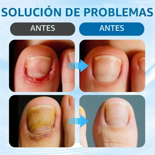 Vista 6 de Juego de corrector de uñas encarnadas con tiras correctoras, kit de eliminación de uñas encarnadas, parche corrector, herramientas de pedicura