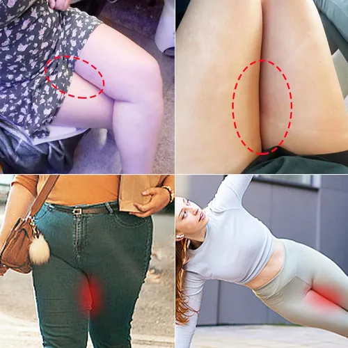 Vista 6 de Almohadillas antirozaduras interiores para muslos, parches invisibles transparentes de cinta de fricción para levantar muslos, protección