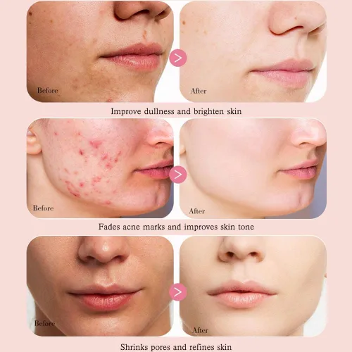 Vista 3 de Peach 70 - Suero de niacinamida, suero corrector de manchas oscuras para hidratación facial, suero facial para piel grasa, limpieza diaria