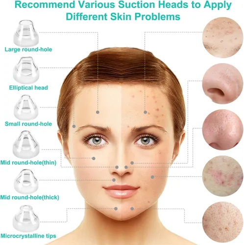 Vista 5 de Aspiradora eliminadora de puntos negros, limpiador eléctrico de poros facial 2021, herramienta extractor de acné recargable por USB, kit