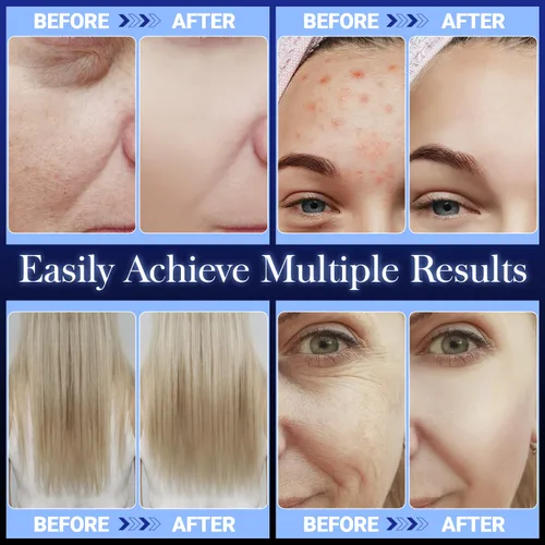 Vista 4 de Uaike - Varita facial de alta frecuencia, portátil, portátil, de mano, azul, de alta frecuencia, para el hogar, dispositivo de varita facial con 4