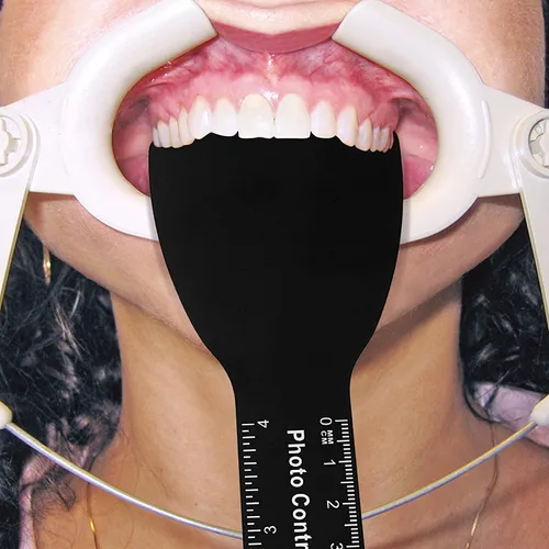 Vista 4 de PROTECTOR Kit de contraste de fotos dentales de 6 piezas de contratista dental fotográfico dental negro