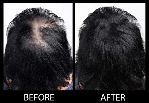 Vista 6 de Fibras capilares voluminizadoras con queratina real para adelgazar el cabello/pérdida de cabello – Dermatológicamente probado y certificado