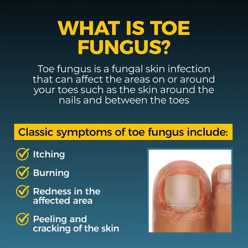 Vista 7 de Fungi-Nail Aplicador en Pluma Solución Antifúngica, Mata los Hongos que Pueden Causar Infecciones en las Uñas y Pie de Atleta con Tolnaftato
