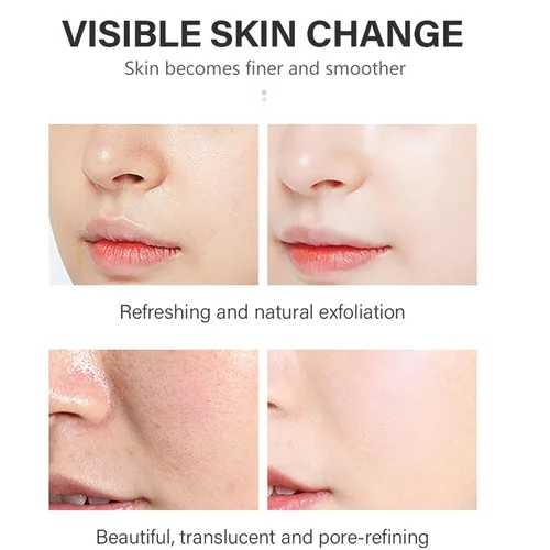 Vista 3 de Solución de ácido salicílico (1.0 fl oz), solución de ácido salicílico al 2%, suero exfoliante suave para una piel más suave y clara, suero facial