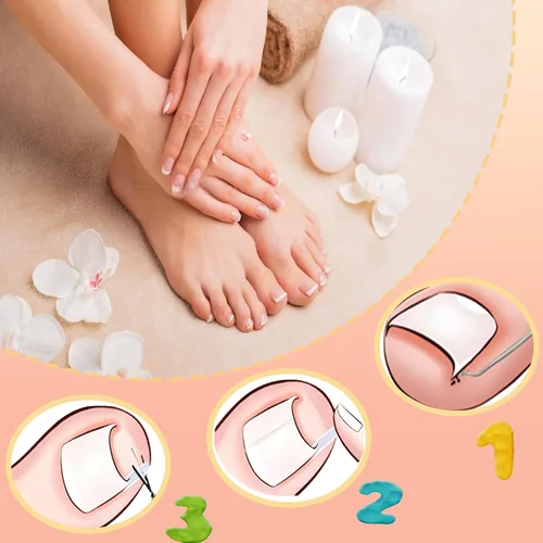 Vista 3 de Kit corrector de uñas encarnadas con tiras de corrección flexibles y cinta – Juego de herramientas profesionales de pedicura en el hogar