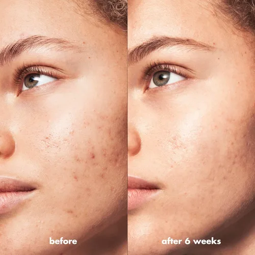 Vista 5 de e.l.f. SKIN Blemish Breakthrough - Crema de agua calmante Mini, hidratante facial ligero que combate las manchas, evita nuevas imperfecciones