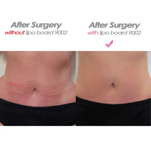 Vista 4 de Lipo Board Abdominal Flattening Post Cirugía Abdominal Compresión Lipo Plantilla Abs Planos Fajate 9002 Desnudo