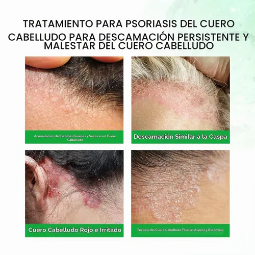 Vista 3 de Roycederm Champú para la psoriasis, tratamiento medicado para el cuero
