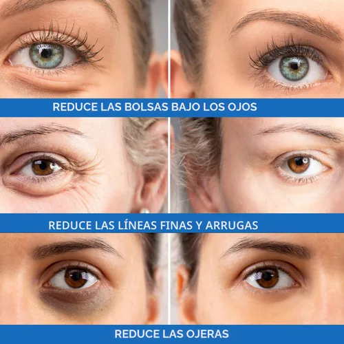 Vista 3 de Tratamiento rápido de hinchazón debajo de los ojos y ojeras: reduce instantáneamente la apariencia de bolsas hinchadas para los ojos, patas de gallo