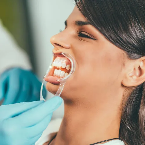 Vista 5 de 10 piezas de retractor de mejillas en forma de C, abridor de boca desechable para blanqueamiento dental, protector bucal o juego Speak Out