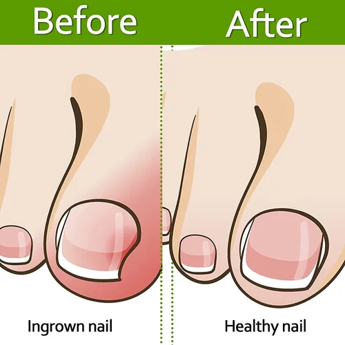 Vista 3 de Tiras correctoras de uñas encarnadas profesionales, 50 tiras correctoras de uñas encarnadas, tiras curvadas para enderezar las uñas del pie, clips