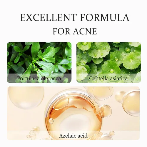 Vista 4 de Crema de Ácido Azelaico al 20% para el Acné Facial, Ácido Azelaico con Ácidos Hialurónicos para el Alivio del Enrojecimiento Facial, Crema