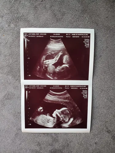 Vista 2 de Broma de ultrasonido 2D personalizada falsa con dos fotos conectadas B&W