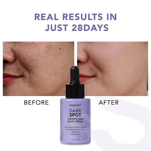 Vista 4 de suquato Suero removedor de manchas oscuras – para hiperpigmentación facial y cuidado del melasma – Corrector de manchas oscuras brillo con ácido