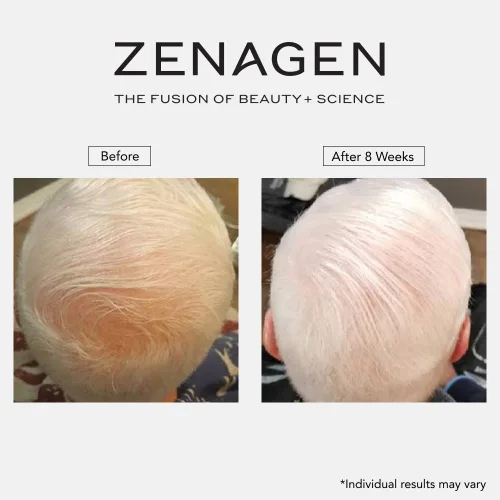 Vista 11 de Zenagen Revolve - Tratamiento de pérdida de cabello para hombres